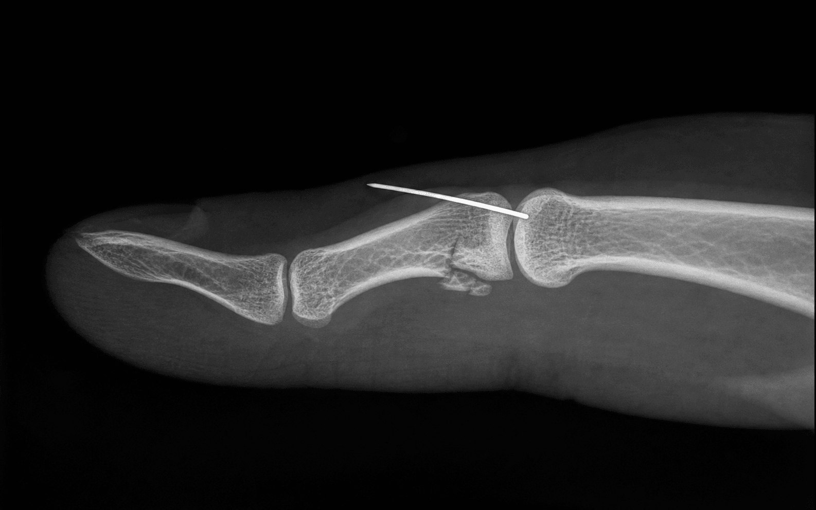 PIP fracture-dislocation pinning