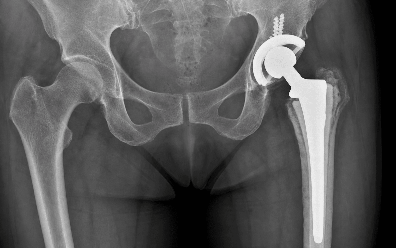 One-stage revision for periprosthetic joint infection