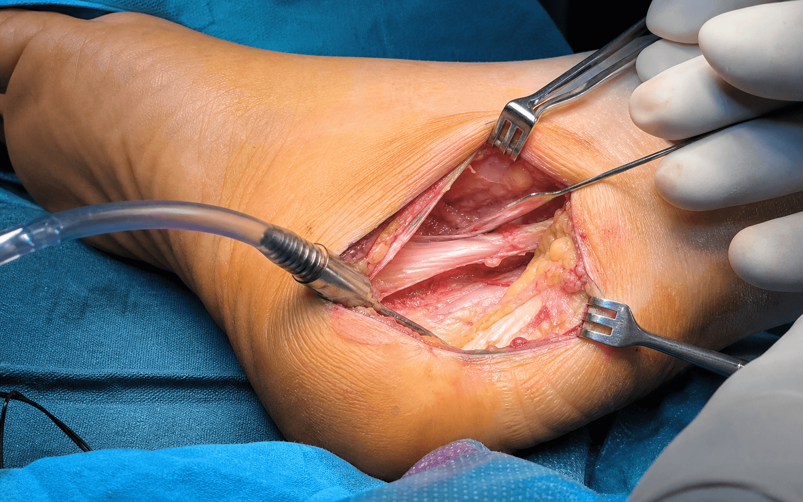 Plantar fascia release