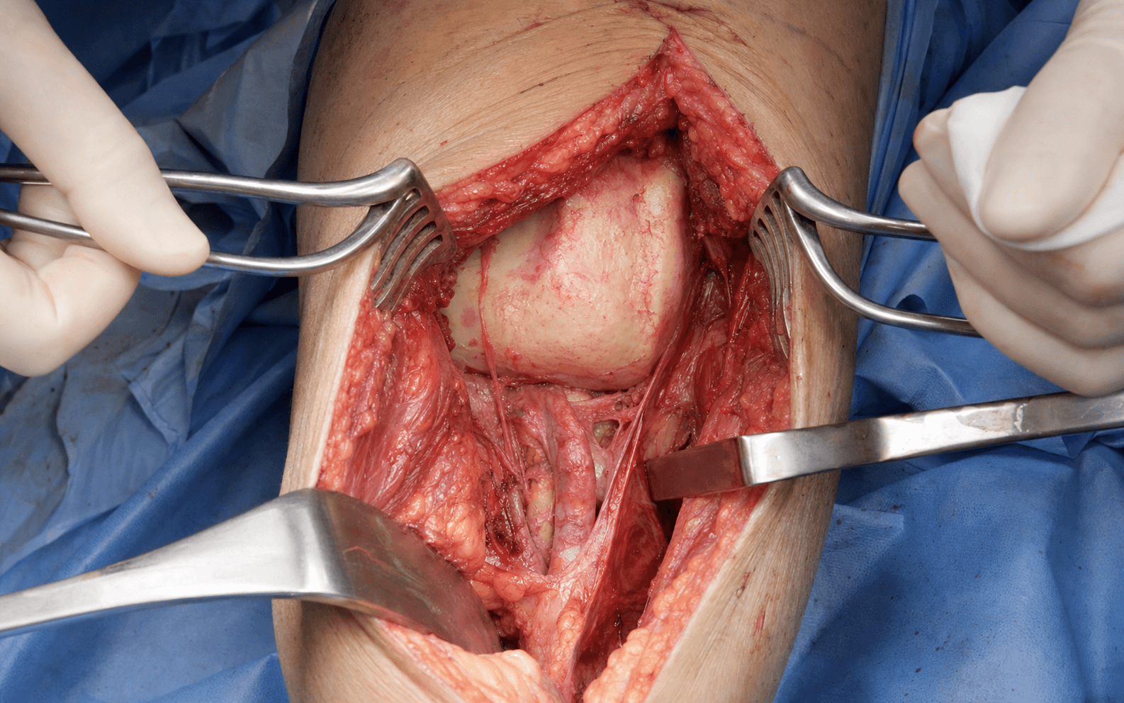 Posterior distal femur approach