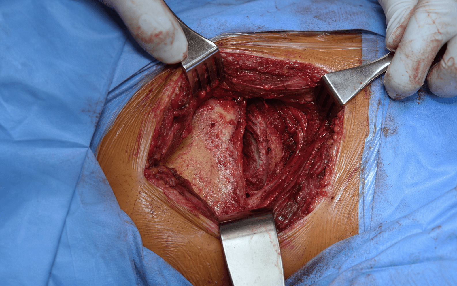 Posterior SI joint approach