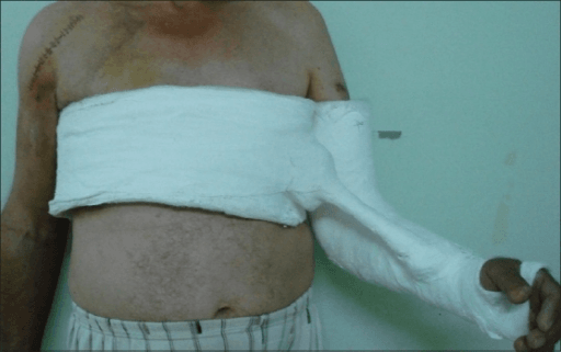 Patient with shoulder immobilised in abduction orthosis after posterior shoulder dislocation surgery