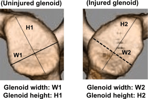 Two glenoid specimens comparing uninjured glenoid and injured glenoid with bone loss measurements H1 W1 and H2 W2