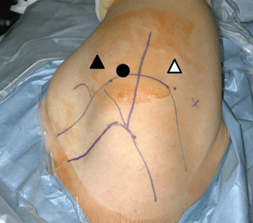 Posterior shoulder approach markings with three symbols showing portal and incision positions on draped operative field