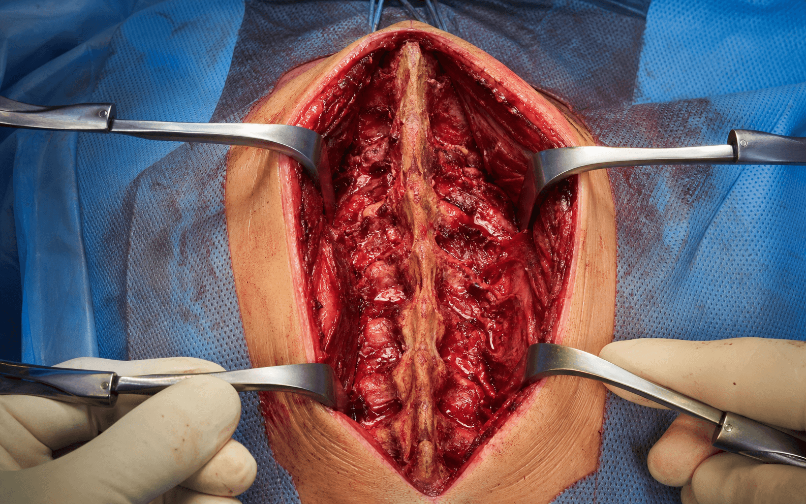 Posterior cervical approach
