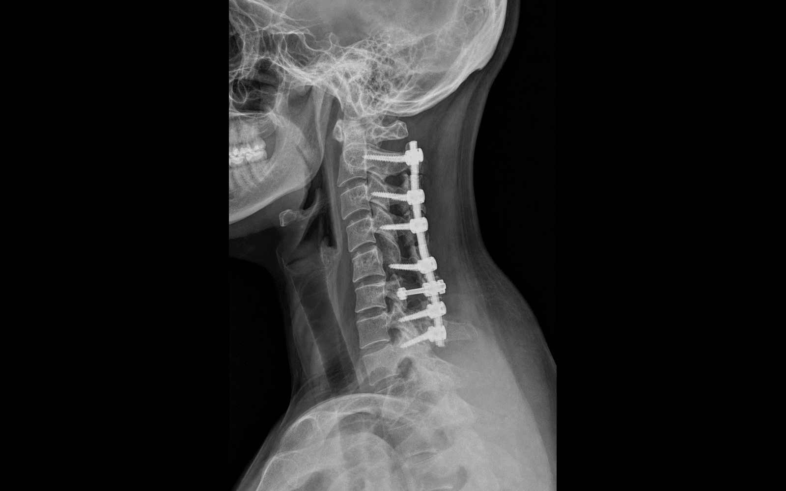 Posterior cervical laminectomy + fusion