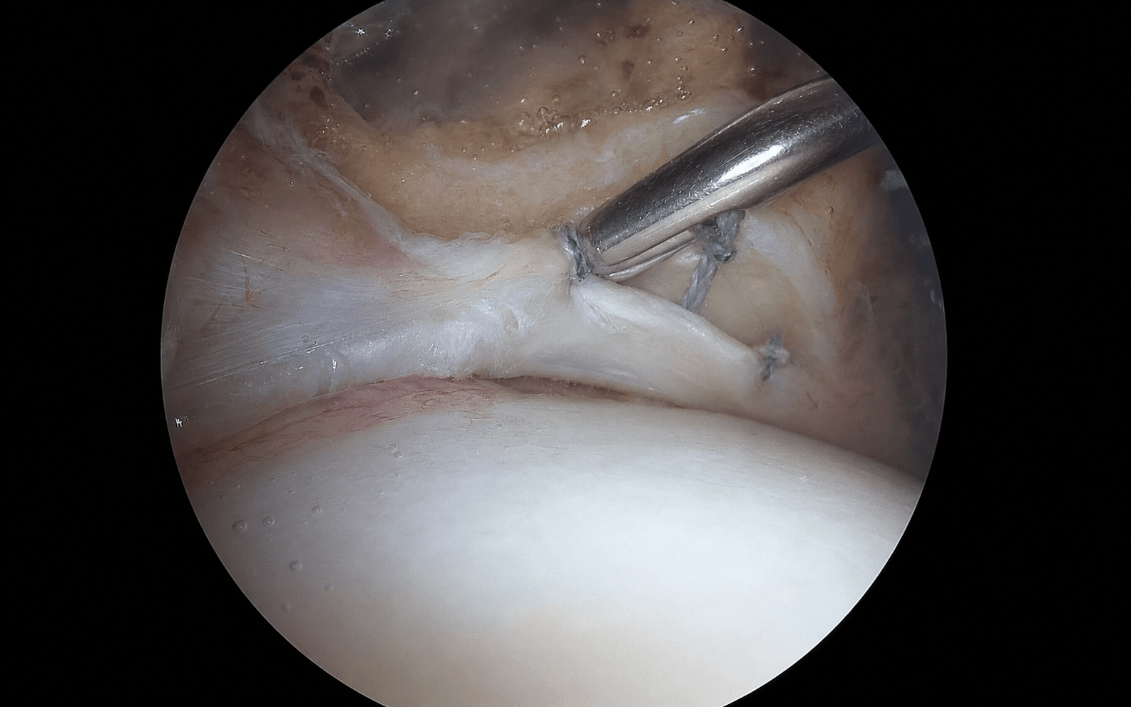 Posterior labral repair
