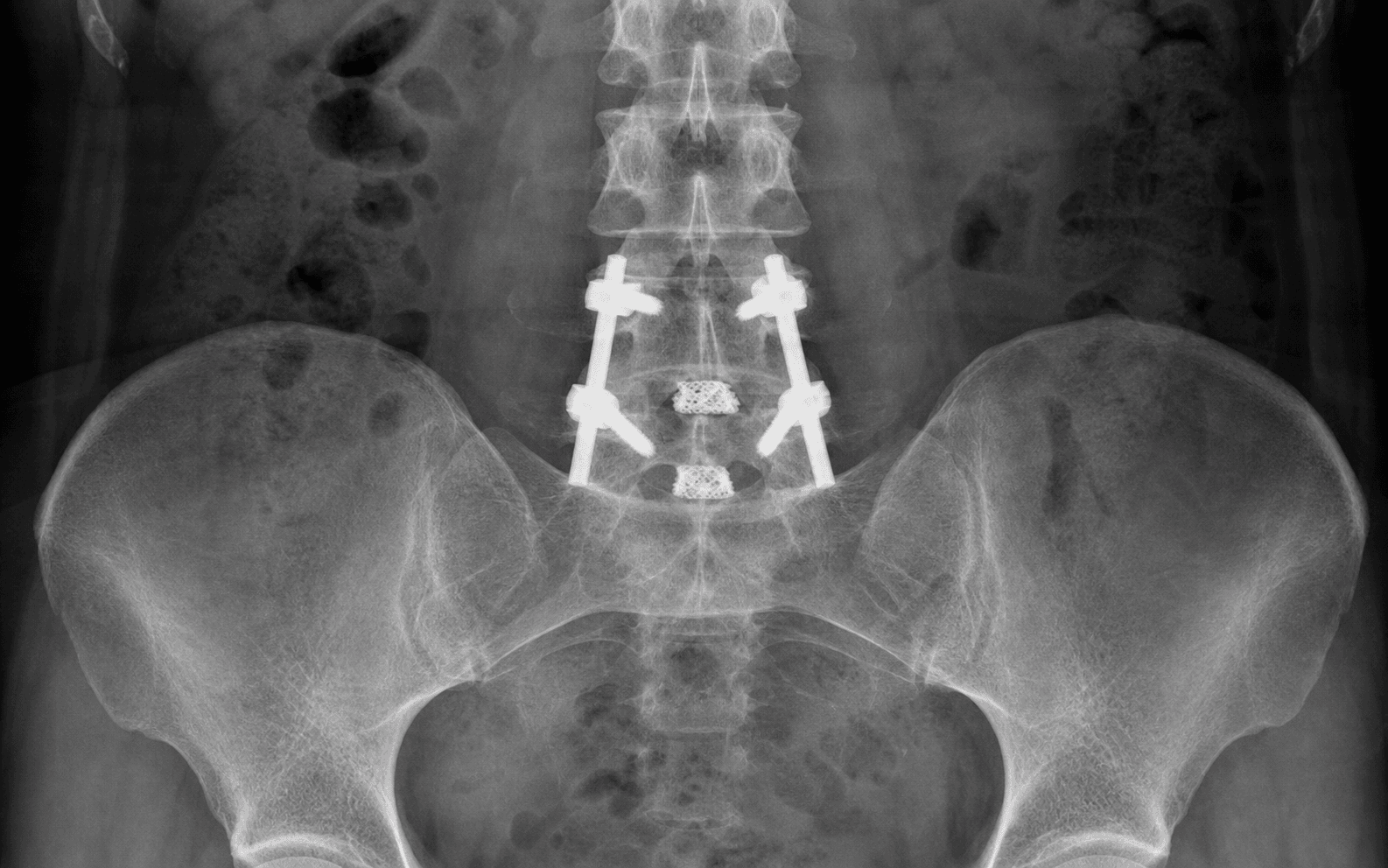 Posterior lumbar decompression and fusion