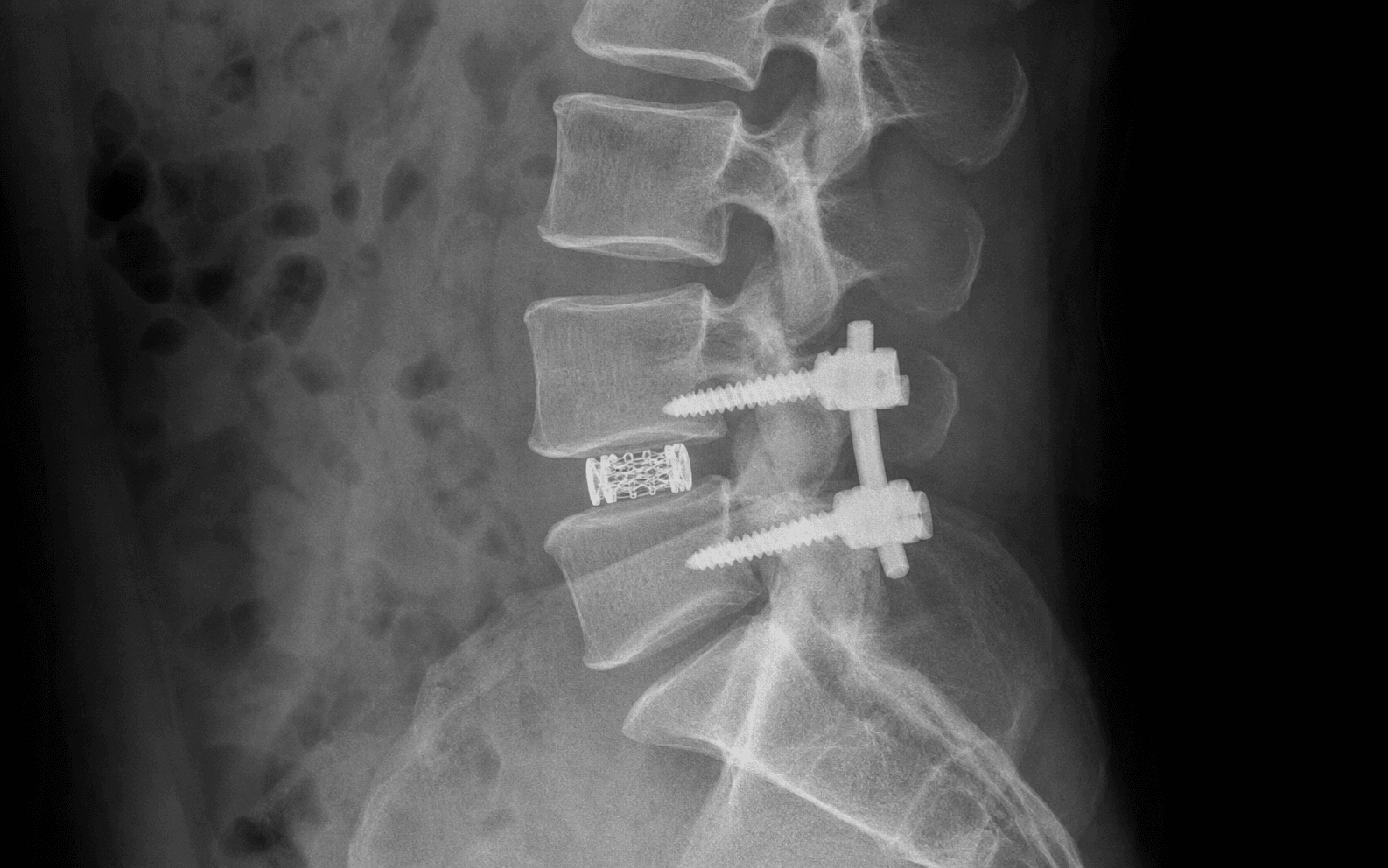 Posterior lumbar interbody fusion with pedicle screws and an interbody cage