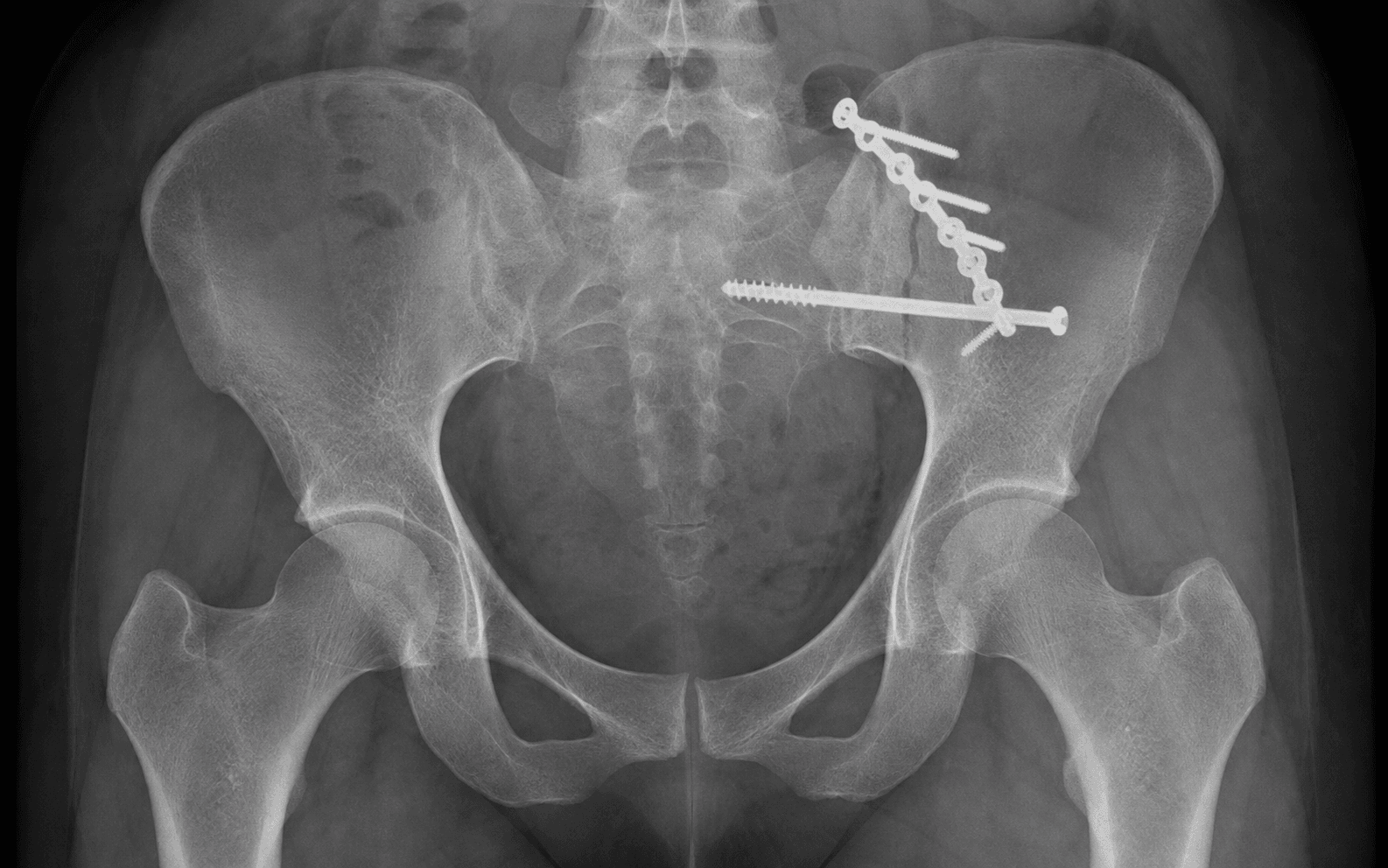 Posterior pelvic ring fixation