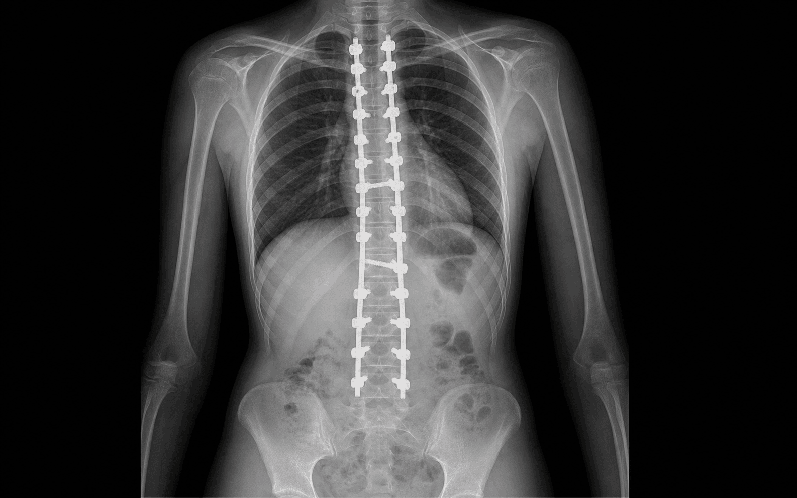 AIS posterior spinal fusion