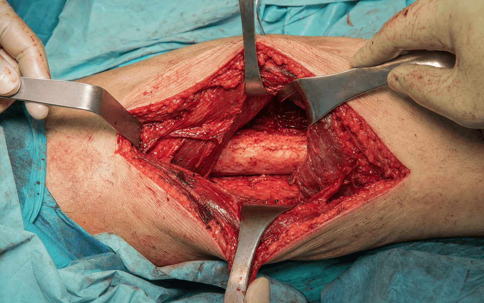 Posterolateral femur approach