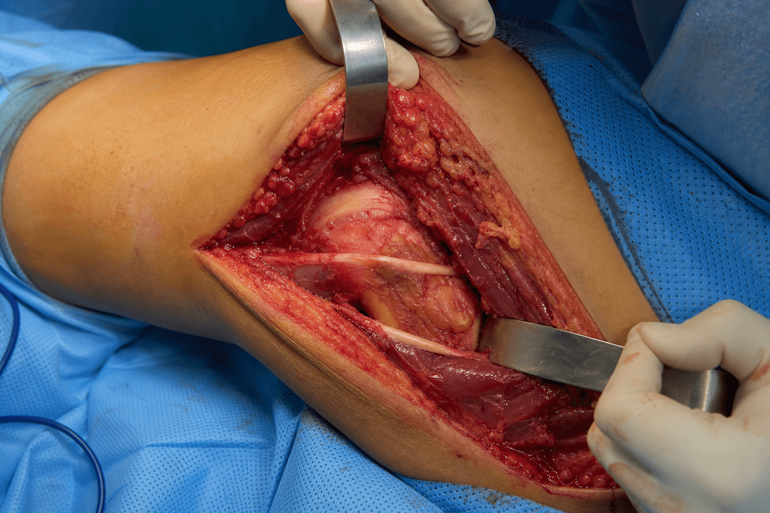 Posterolateral knee approach