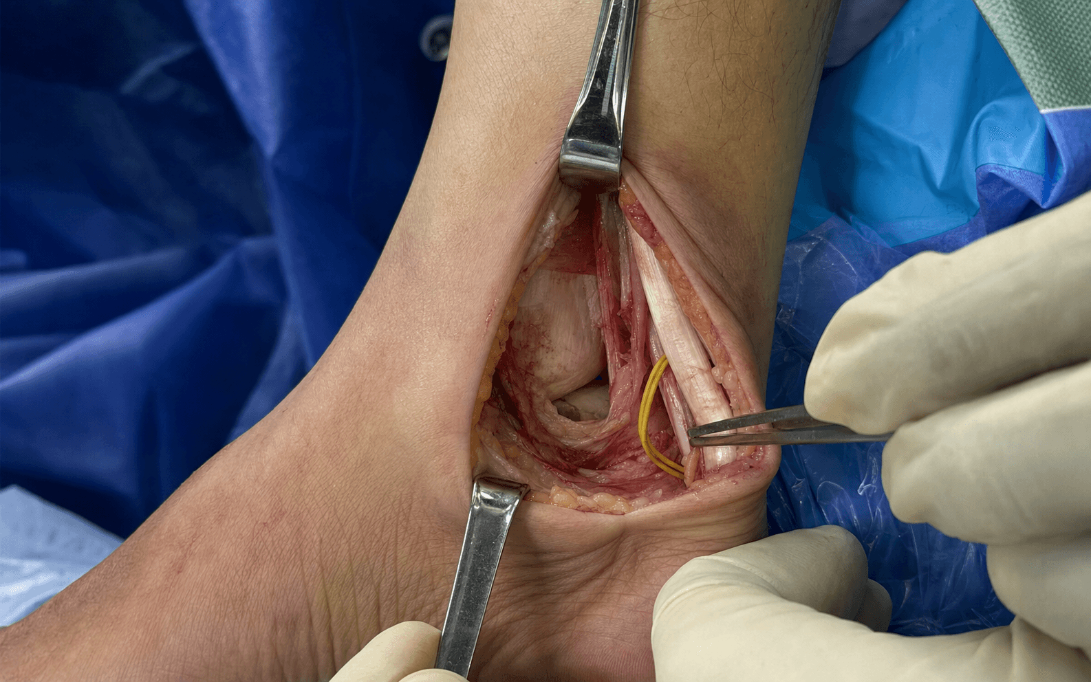 Posteromedial ankle approach