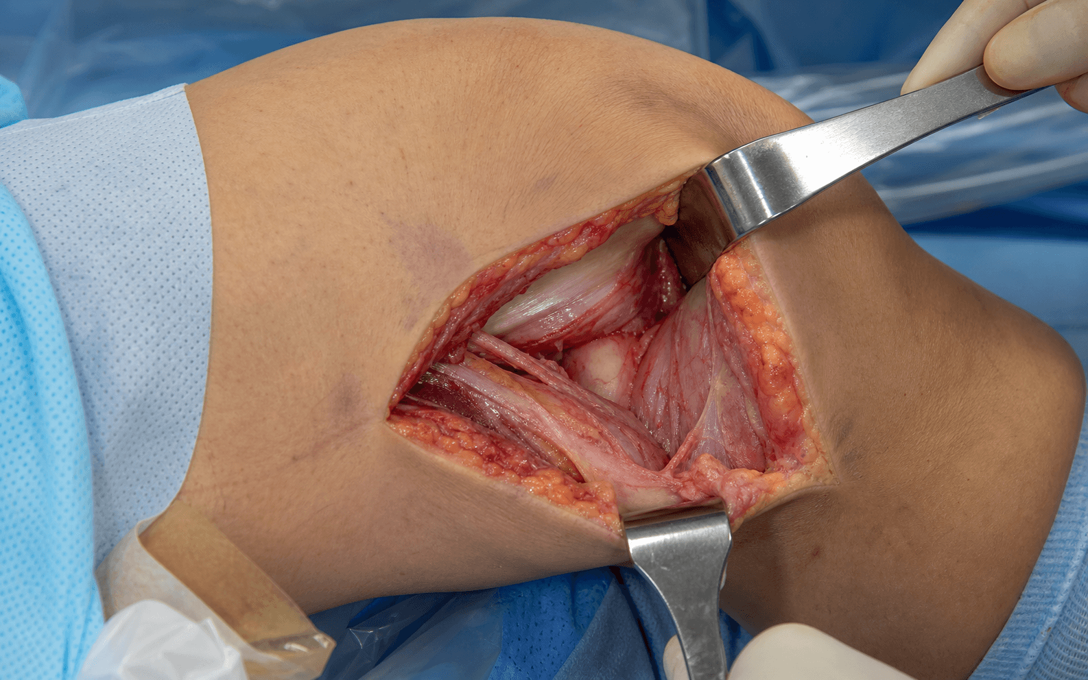 Posteromedial knee approach