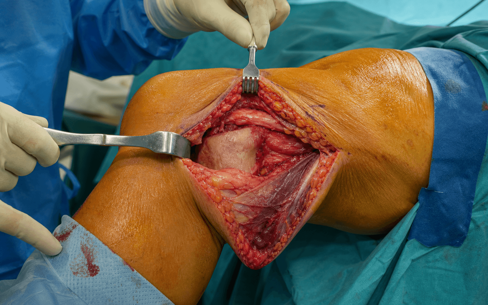 Posteromedial tibial plateau approach