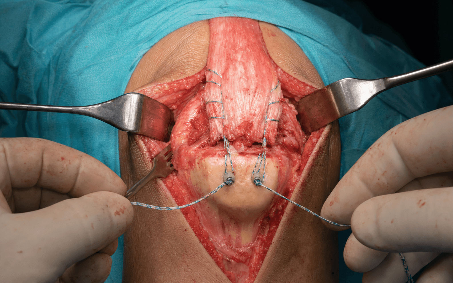 Quadriceps tendon anchor repair