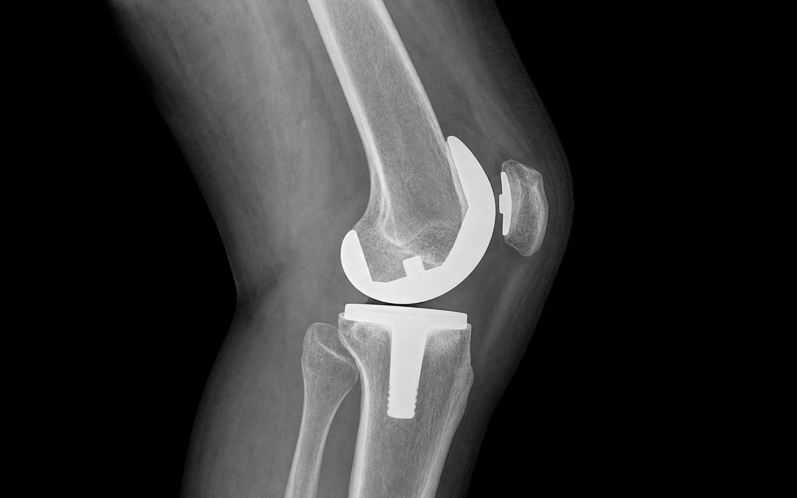 TKA patellar resurfacing