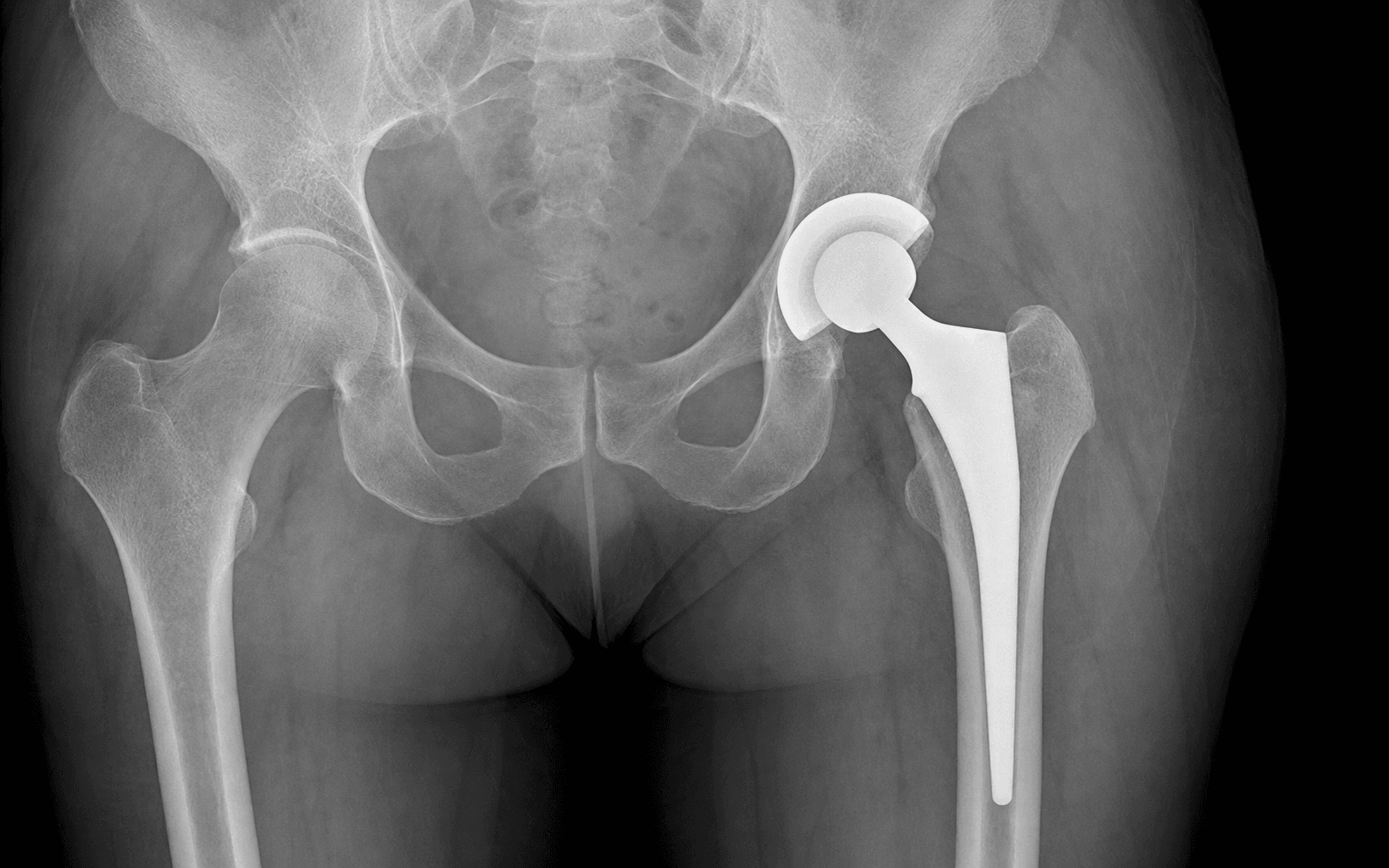Primary total hip arthroplasty
