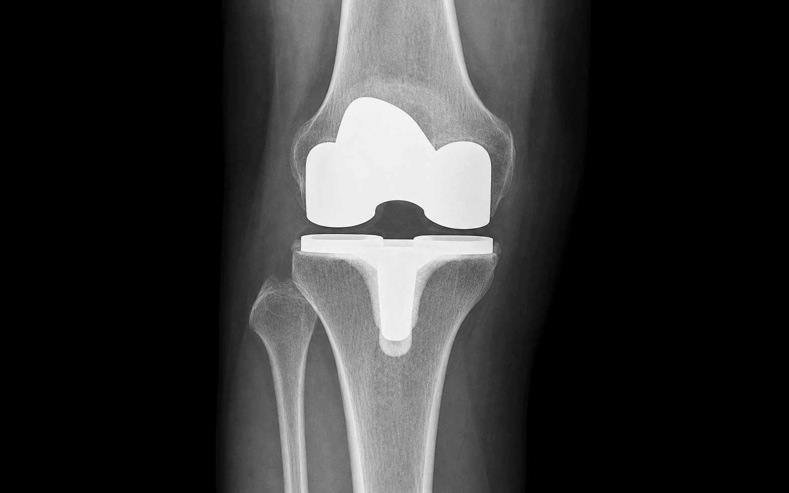 Primary total knee replacement