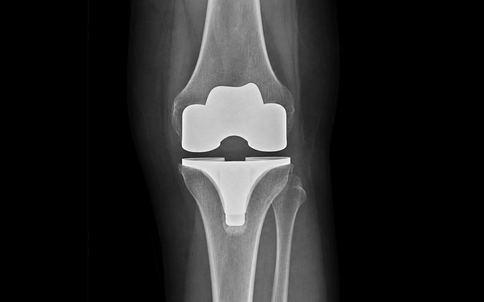 Primary total knee replacement