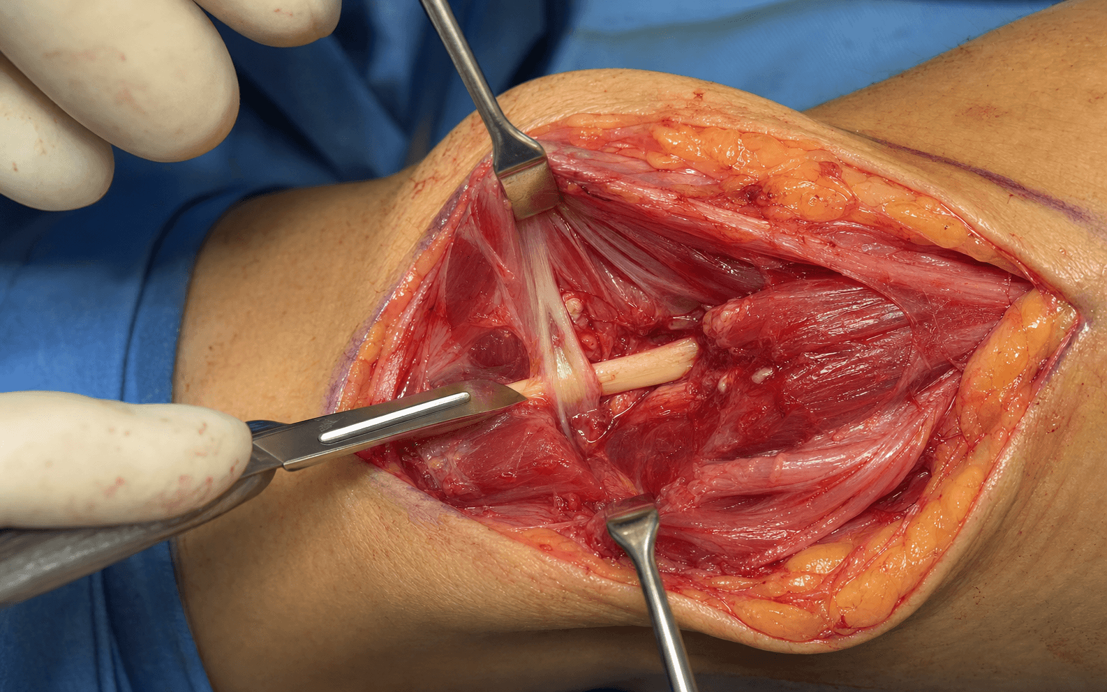 Pronator syndrome release