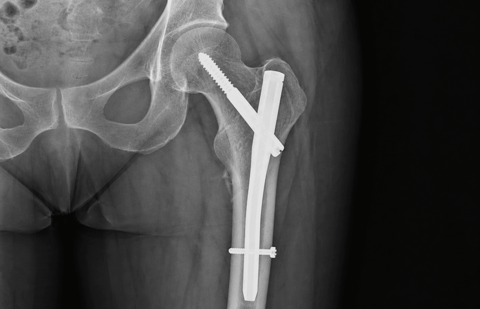 Cephalomedullary nail