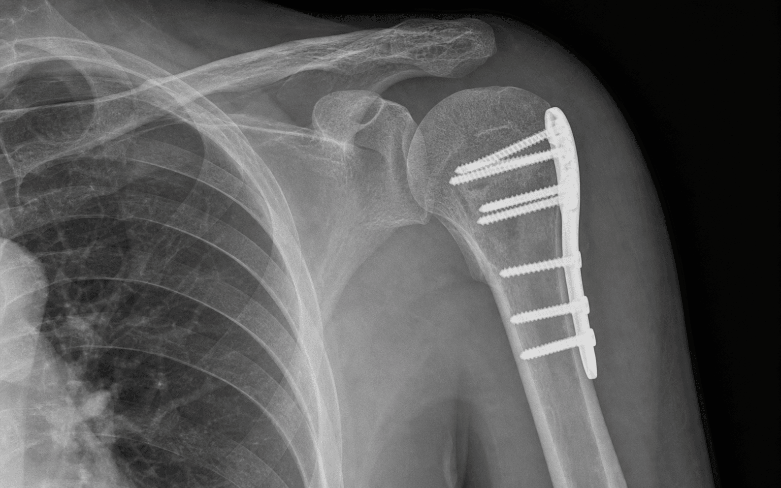 Proximal humerus locking plate