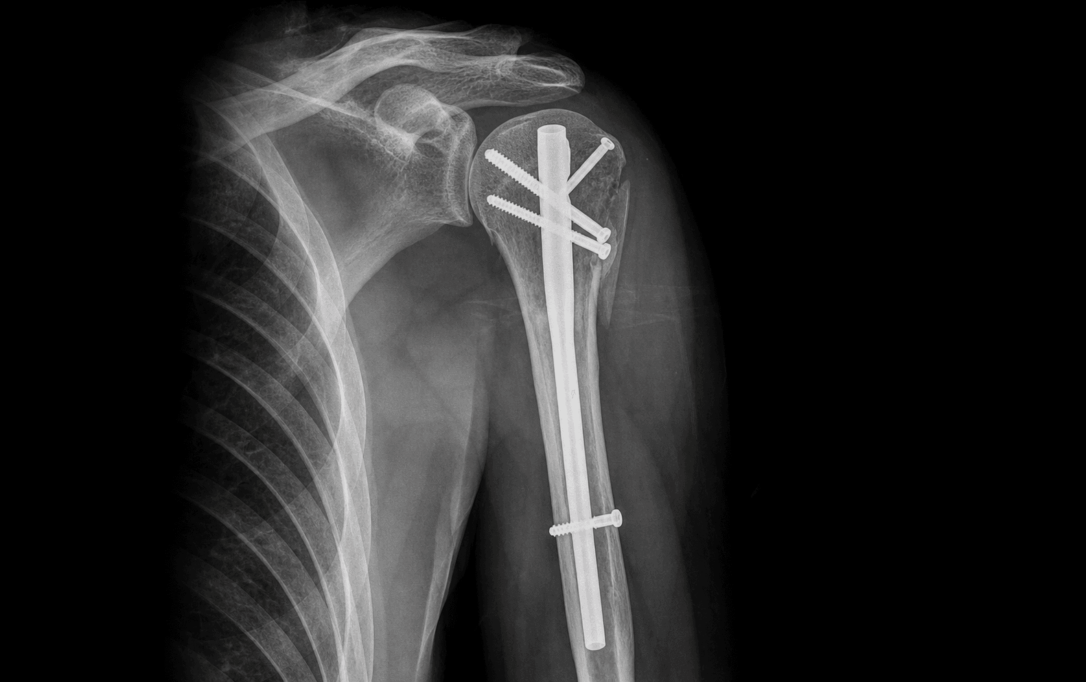 Proximal humerus nailing
