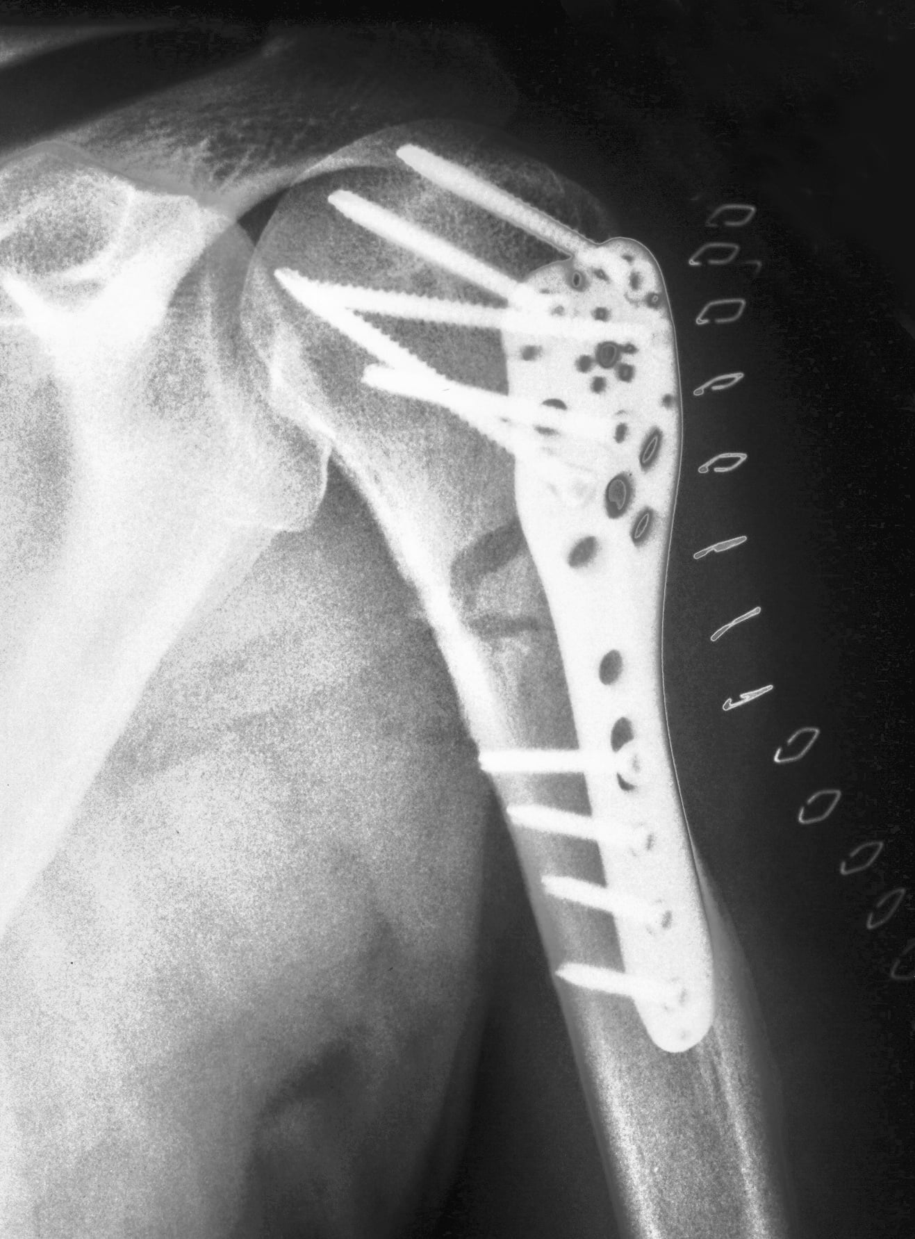 Proximal humerus fracture fixed with a locking plate