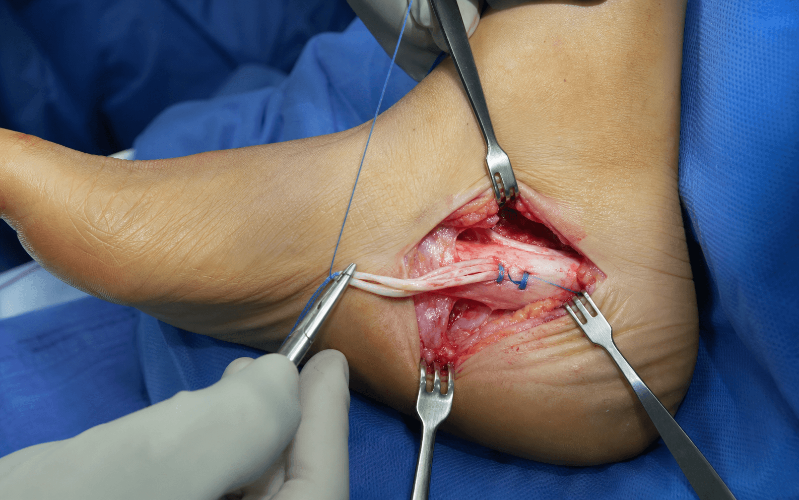 Intra-operative reconstruction for posterior tibial tendon dysfunction