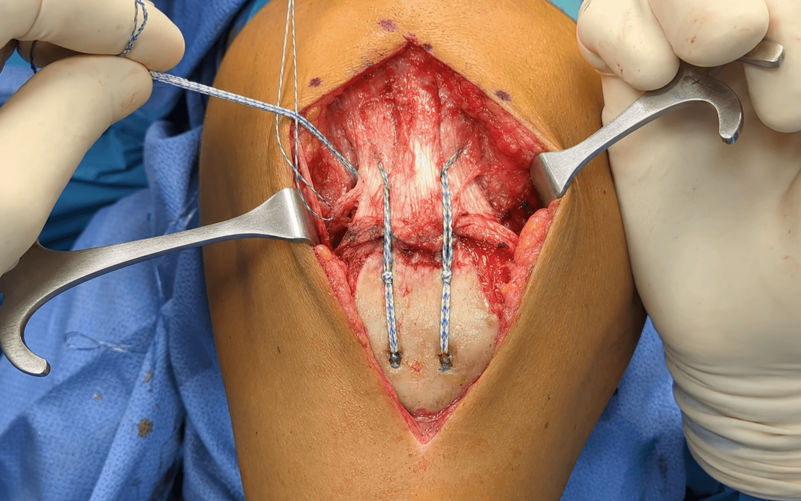 Quadriceps tendon repair