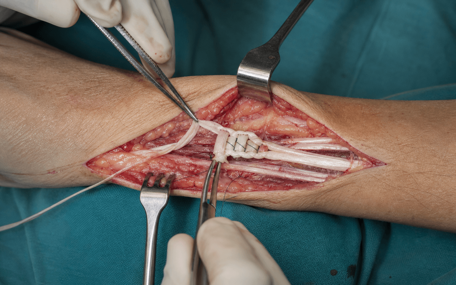 Radial nerve palsy tendon transfers
