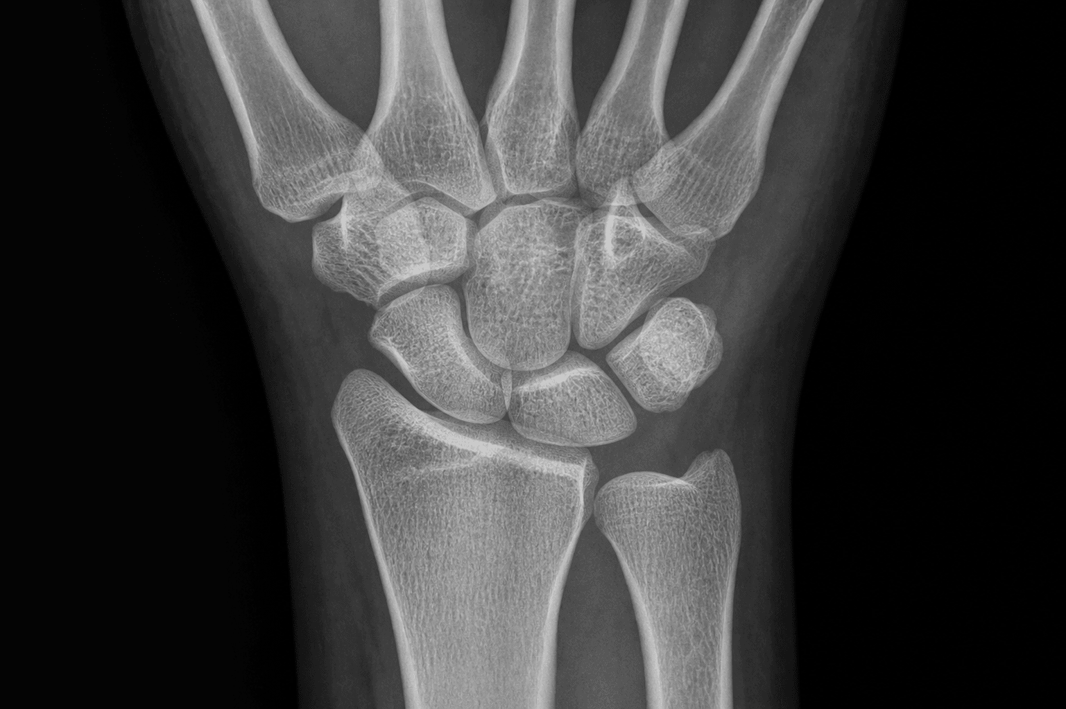 Radial styloidectomy squared contour