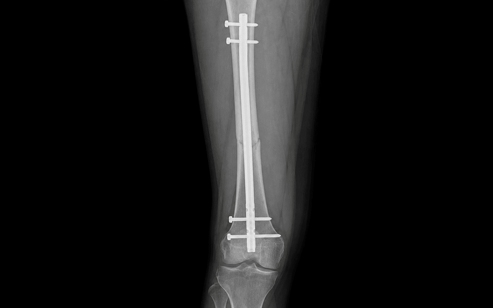 Retrograde femoral nailing