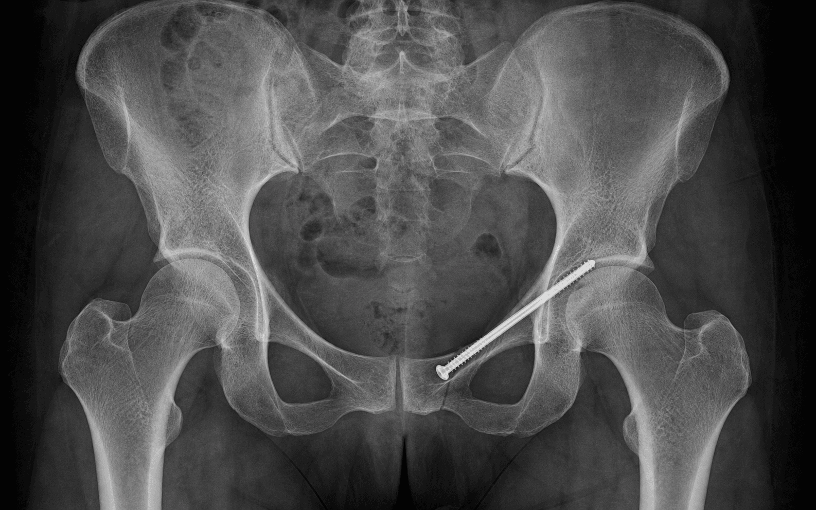 Retrograde superior pubic ramus screw