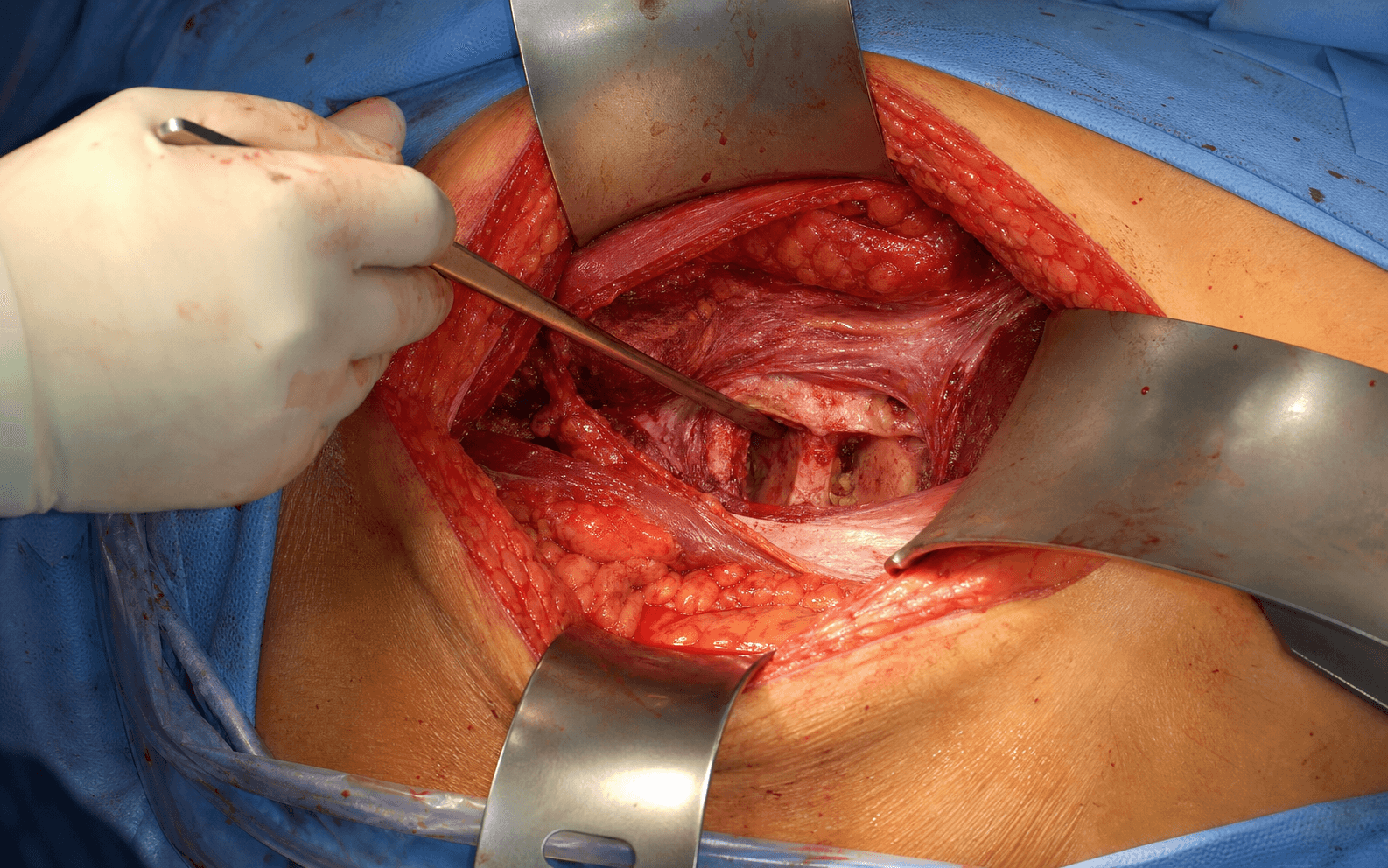 Retroperitoneal anterolateral lumbar approach