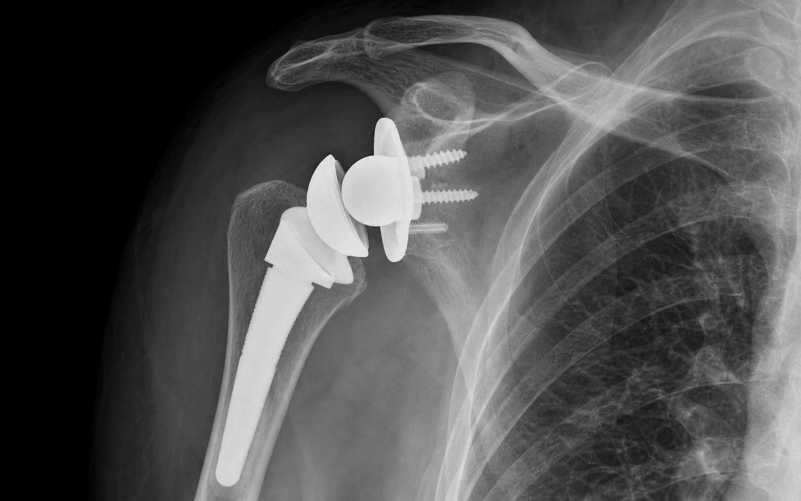 RSA for proximal humerus fracture