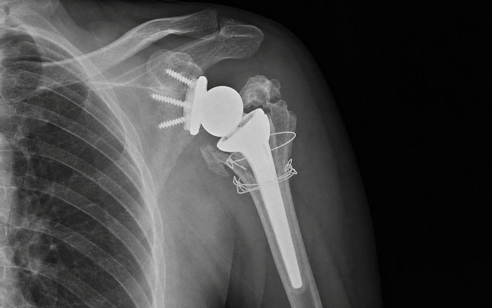 Reverse shoulder arthroplasty