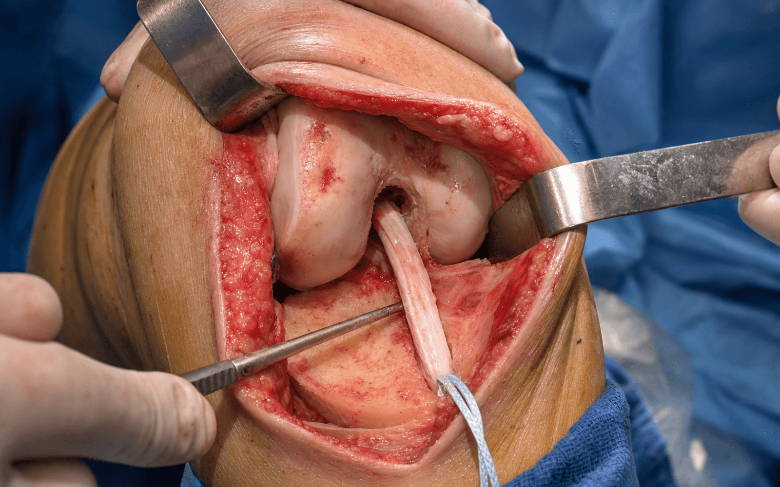 Revision ACL reconstruction