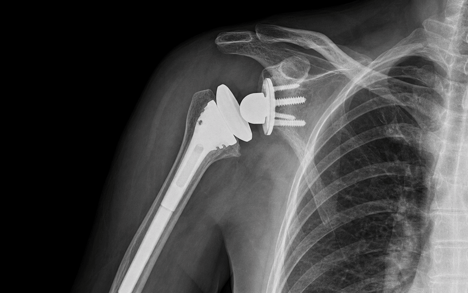 Revision to reverse shoulder