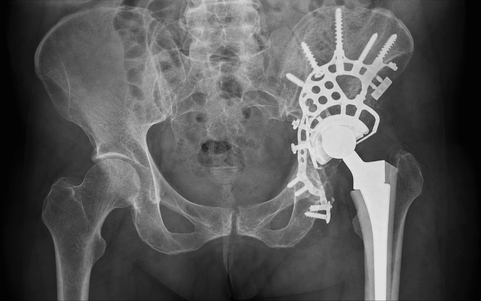 Cup-cage for pelvic discontinuity