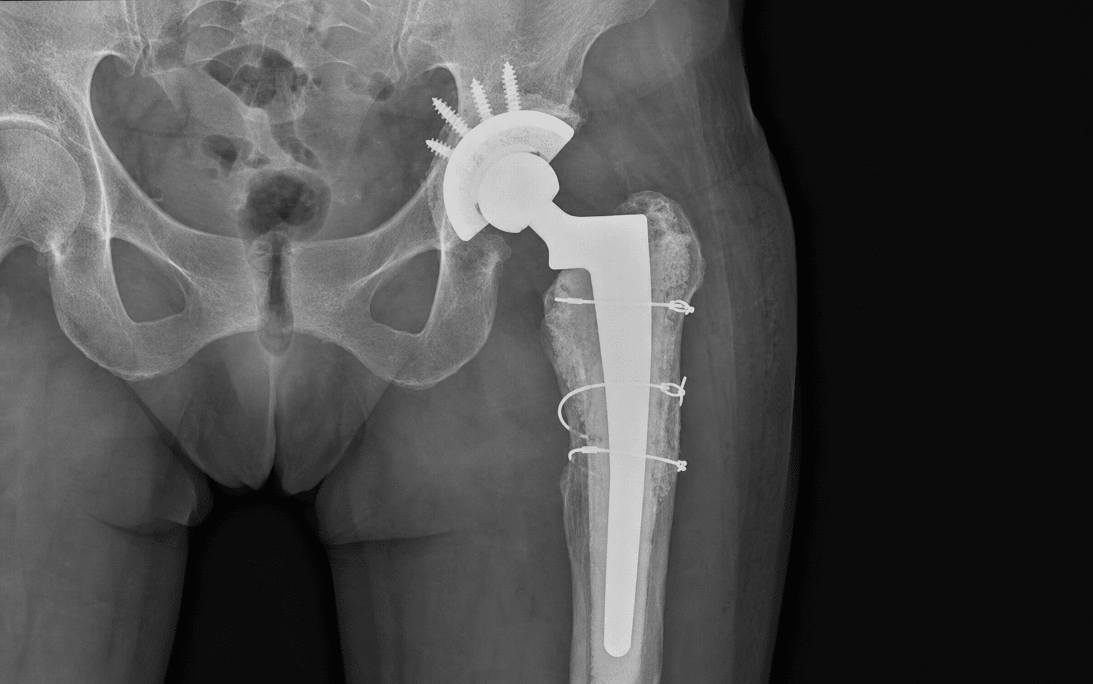 Femoral impaction grafting revision