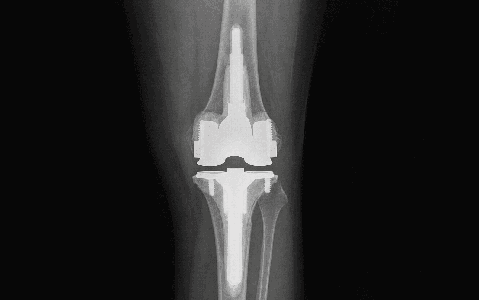 Revision TKA stems/augments