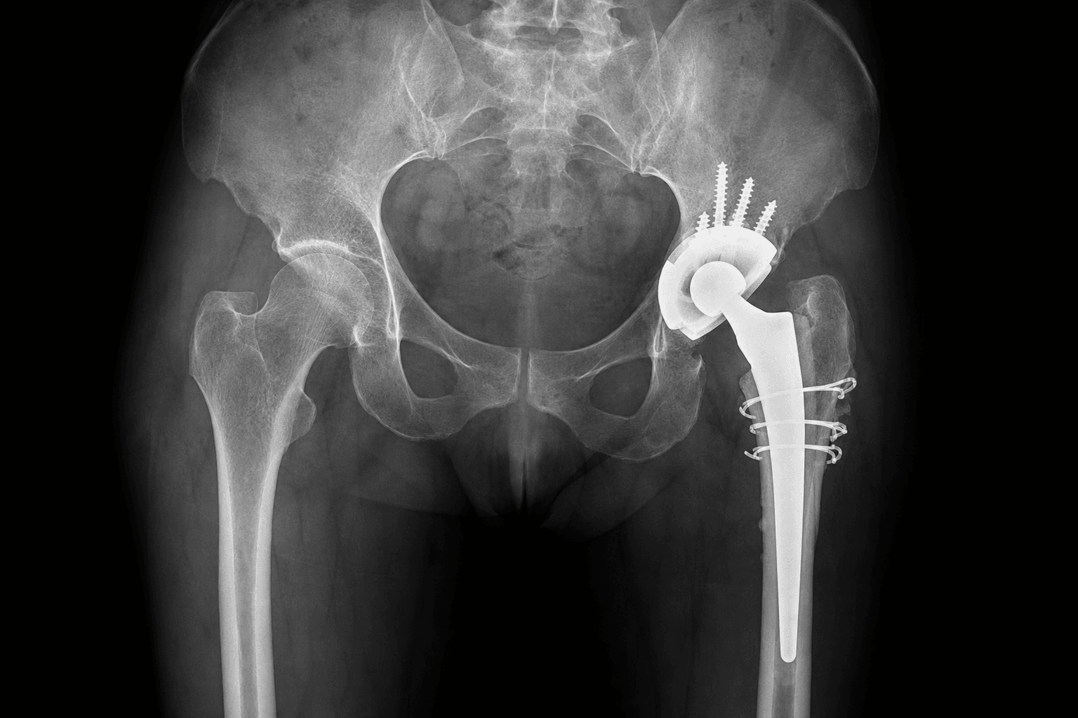 Revision total hip replacement