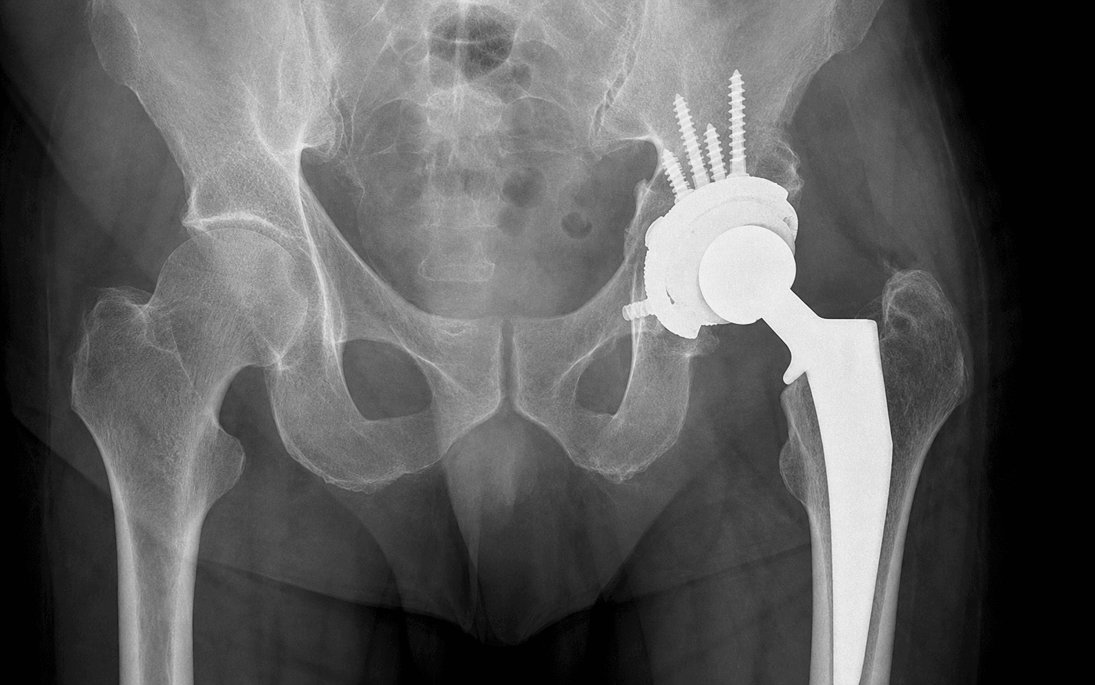 Acetabular component revision