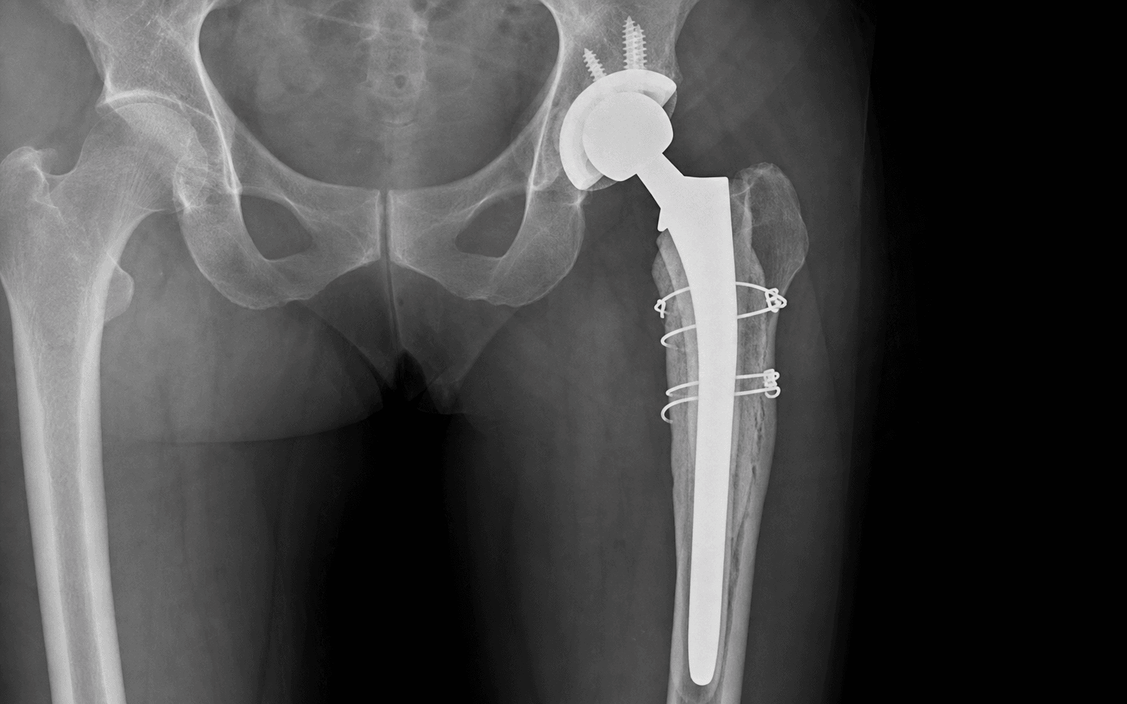 Femoral component revision