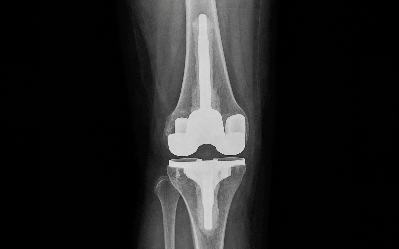 TKR femoral component revision