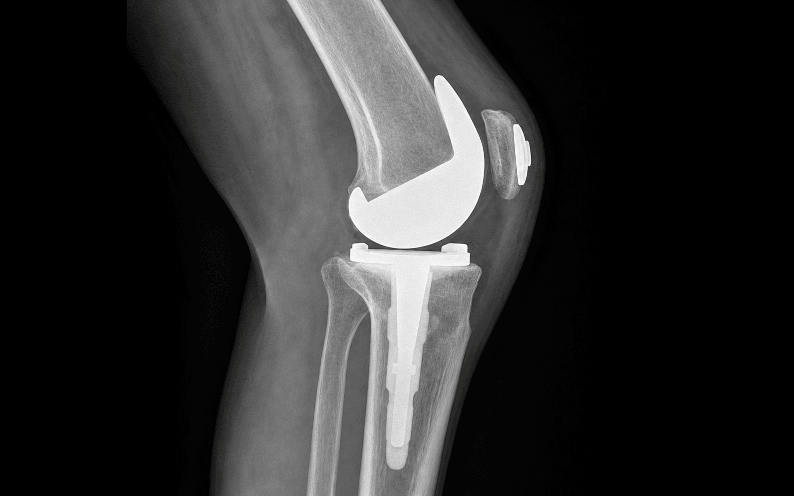 Patellar component revision
