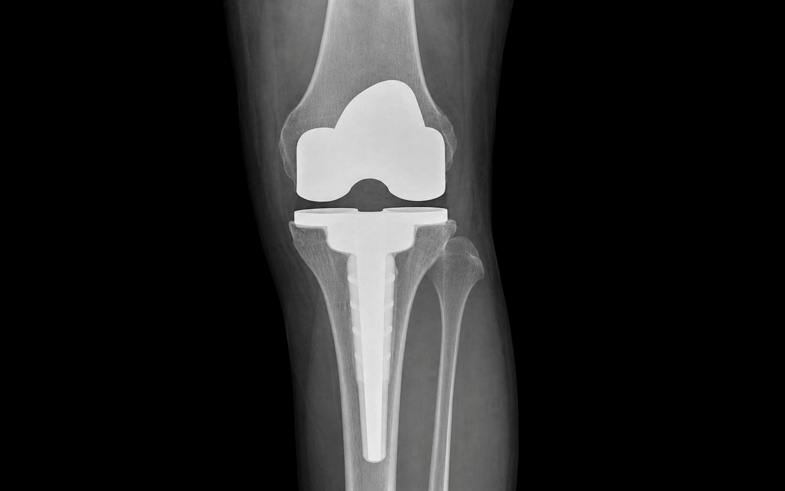 Tibial component revision